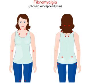 Fibromialgia. Puntos de dolor