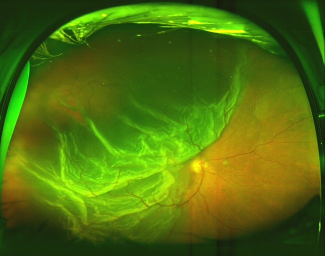 Fotografía de un fondo de ojo donde se aprecia el efecto de "bolsa con pliegues" que hace la retina desprendida parcialmente