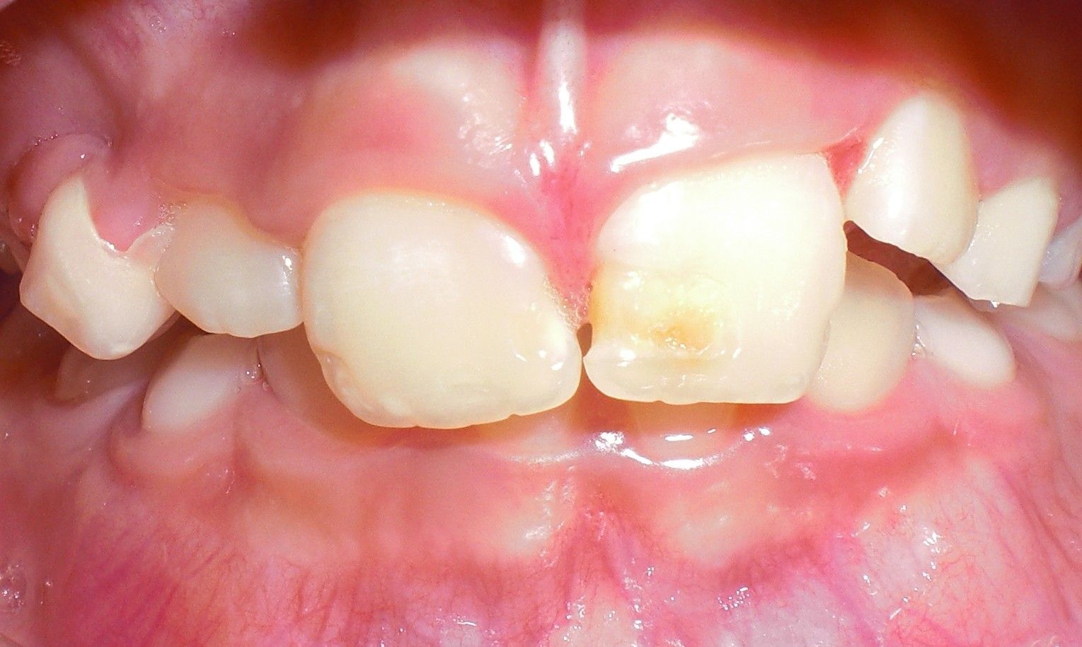Fotografía de un diente con anomalia de esmalte