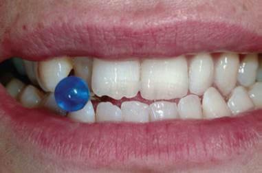Imagen fractura de dientes por piercing lingual