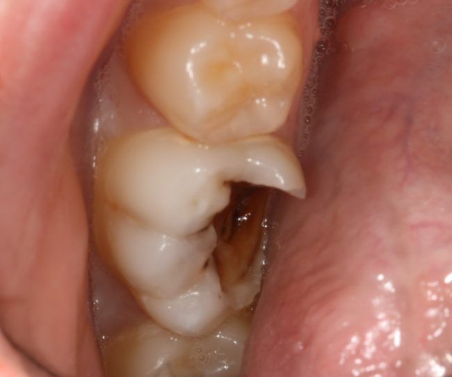 Caries dental que ha destruido la mayor parte de la corona del diente