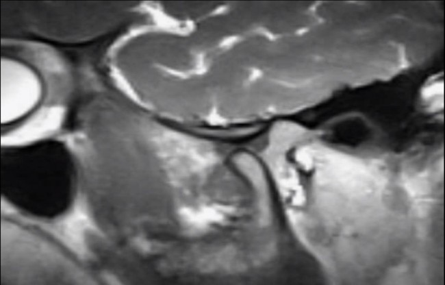 foto resonancia magnetica articulación temporomandibular