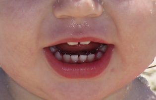 Pediatric oral health is important