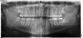 A panoramic radiograph created with a CRANEX® D digital panoramic X-ray system