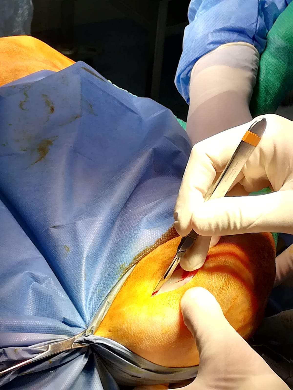Técnica quirúrgica - lesión condral
